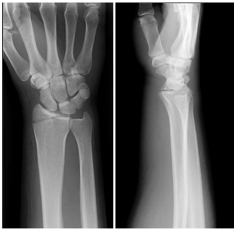 Distal Radius Fractures and Splinting — Kwak Talk Distal Radius Fractures and Splinting — Kwak Talk